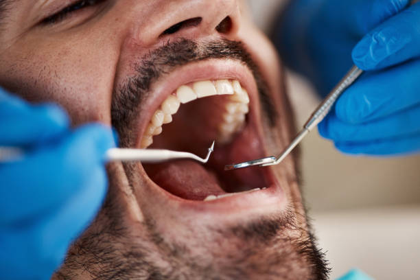 Best Emergency Wisdom Teeth Removal in Mount Airy, MD